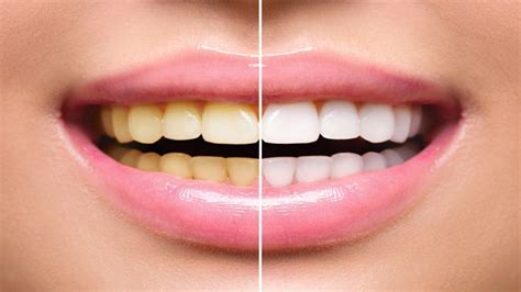 Mud Teeth Whitening: Reveal Your Natural Smile